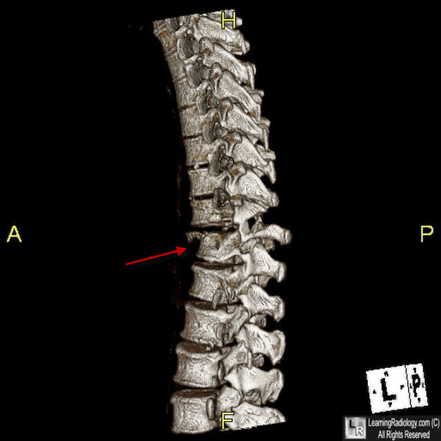 Chance Fracture